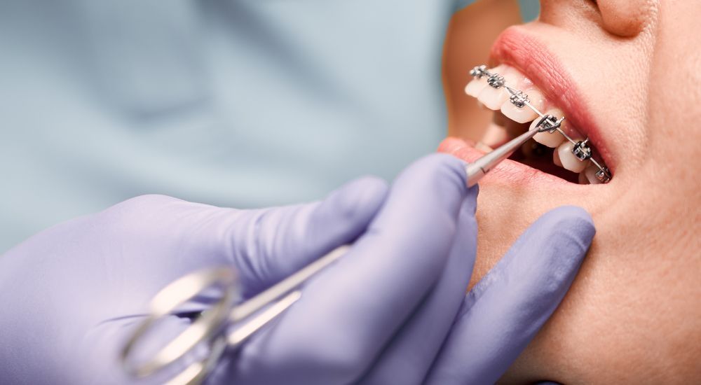 Zakładanie aparatu ortodontycznego